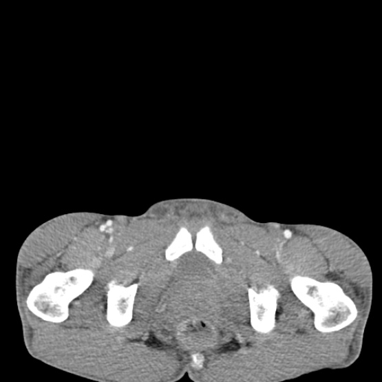 Chronic large bowel pseudo-obstruction (Radiopaedia 43181-46492 A 163).jpg