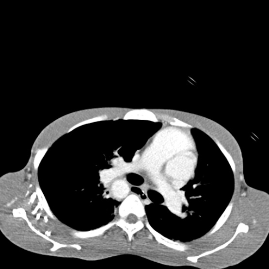 Chronic large bowel pseudo-obstruction (Radiopaedia 43181-46492 A 7).jpg