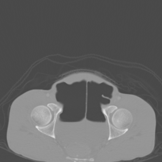 Chronic large bowel pseudo-obstruction (Radiopaedia 43181-46492 Axial bone window 153).jpg