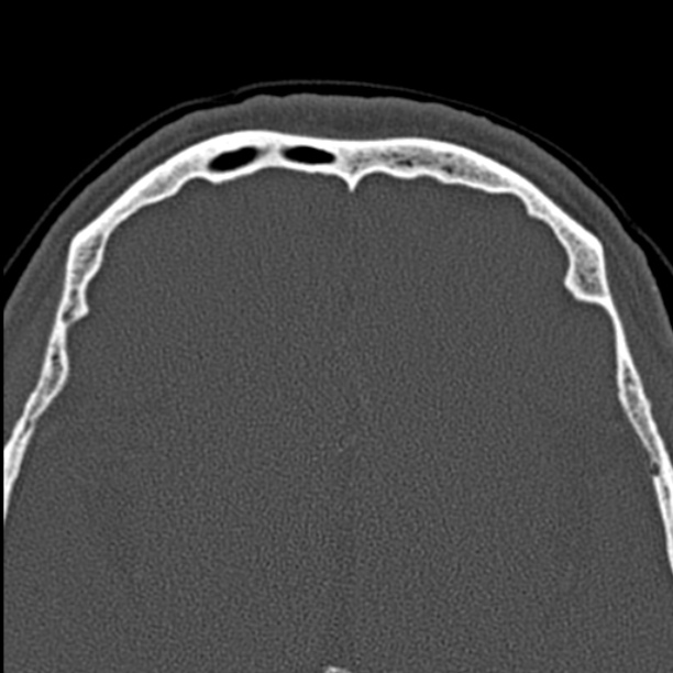 Chronic maxillary sinusitis (Radiopaedia 27879-28116 Axial bone window 52).jpg