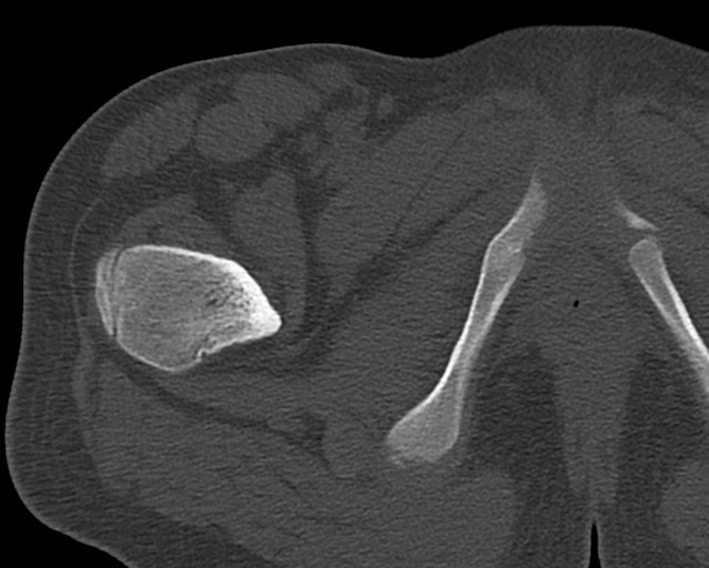 Chronic ostemyelitis of the femur with long sinus tract (Radiopaedia 74947-85982 Axial bone window 16).jpg