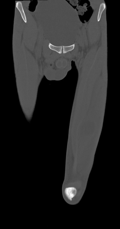 Chronic osteomyelitis (with sequestrum) (Radiopaedia 74813-85822 Coronal non-contrast 10).jpg
