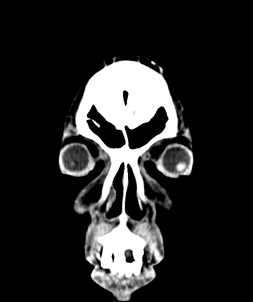 Chronic osteomyelitis - calvarial (severe) (Radiopaedia 69668-79616 Coronal non-contrast 9).jpg