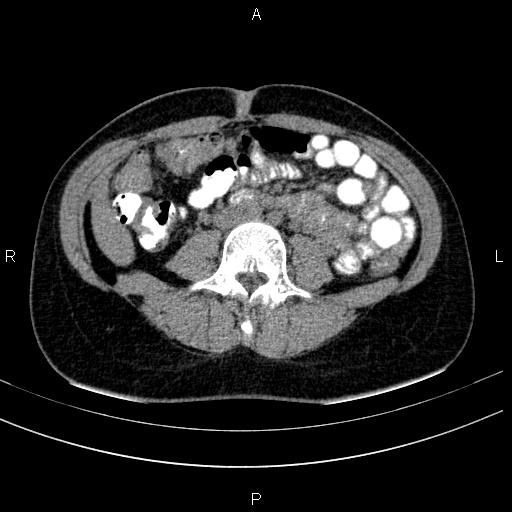 Chronic pancreatitis (Radiopaedia 64576-73450 Axial non-contrast 93).jpg
