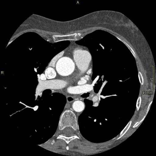 Chronic pulmonary embolism (Radiopaedia 73073-85094 Axial C+ CTPA 71).jpg