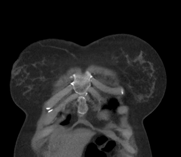 Chronic pulmonary embolus (Radiopaedia 39129-41341 Coronal C+ CTPA 12).png