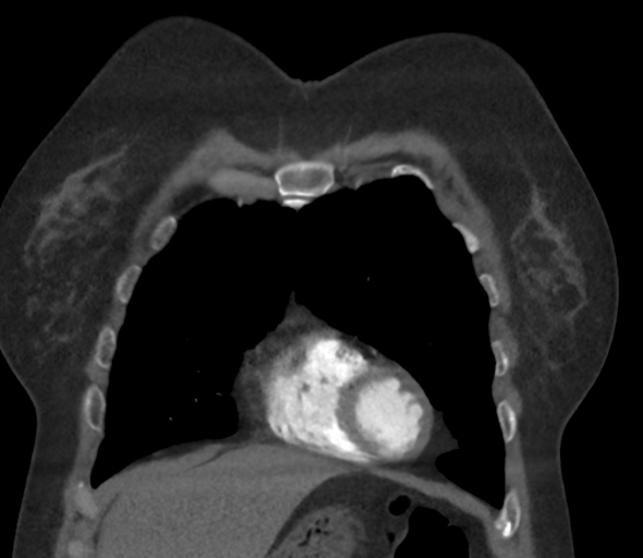 File:Chronic pulmonary embolus (Radiopaedia 39129-41341 Coronal C+ CTPA 21).png