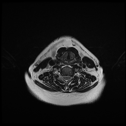 File:Chronic submandibular sialadenitis (Radiopaedia 61852-69885 Axial T2 20).jpg