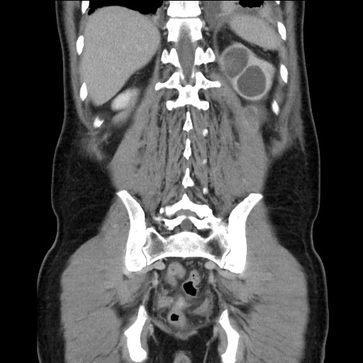 Chronic ureteropelvic junction obstruction (Radiopaedia 78365-90996 B 79).jpg