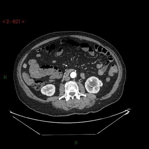 File:Circumaortic left renal vein and doubled left renal arteries (Radiopaedia 52268-58158 A 157).jpg