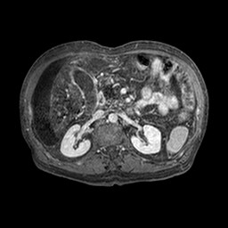 Cirrhosis and hepatocellular carcinoma in the setting of hemochromatosis (Radiopaedia 75394-86594 Axial T1 C+ fat sat 284).jpg