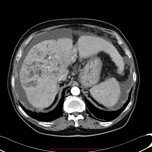 File:Cirrhosis and hepatocellular carcinoma in the setting of hemochromatosis (Radiopaedia 75394-86595 A 25).jpg