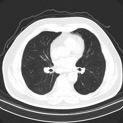 Classic complicated silicosis (Radiopaedia 49720-54961 Axial lung window 31).jpg