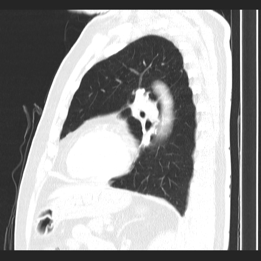 Classic complicated silicosis (Radiopaedia 49720-54961 Sagittal lung window 22).jpg