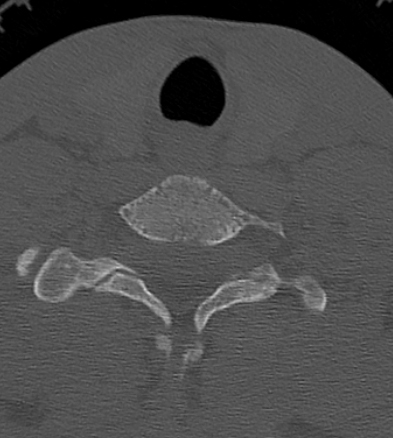 Clay-shoveler fracture (Radiopaedia 14604-14532 Axial bone window 39).jpg