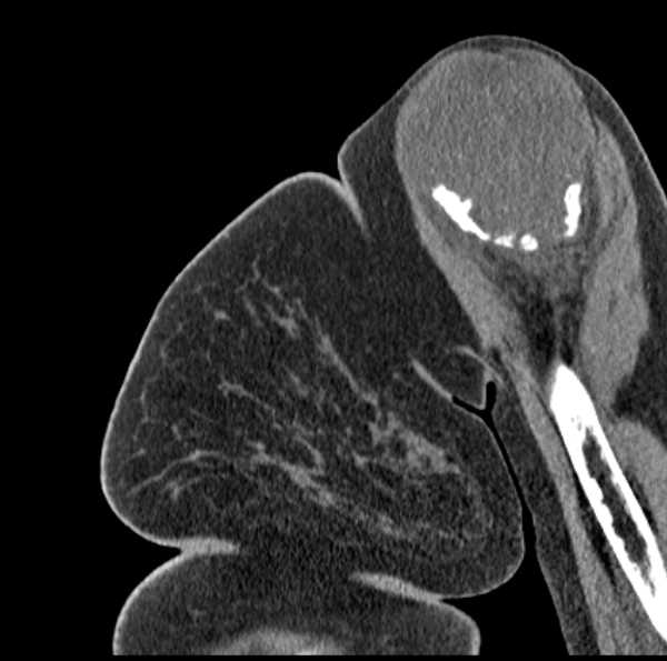 Clear cell chondrosarcoma - humerus (Radiopaedia 63104-71612 D 16).jpg