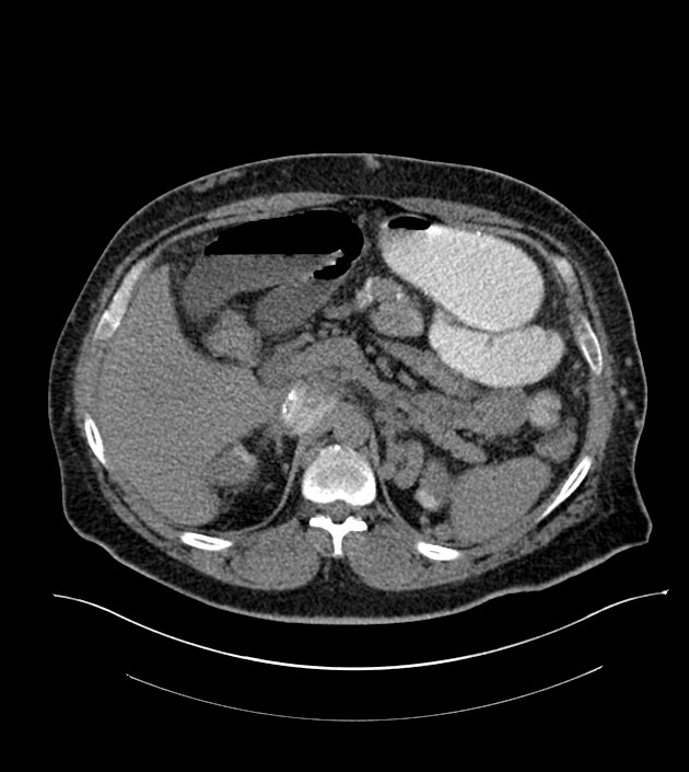Closed-loop small bowel obstruction-internal hernia (Radiopaedia 78439-91096 Axial non-contrast 45).jpg