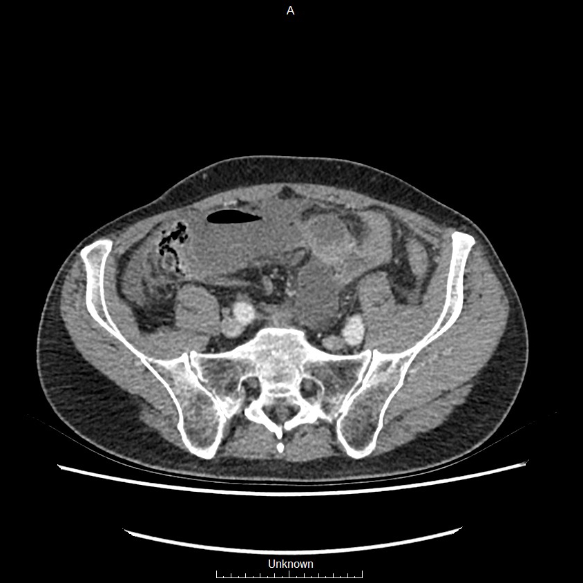 Closed loop bowel obstruction and ischemia (Radiopaedia 86959-103180 A 64).jpg