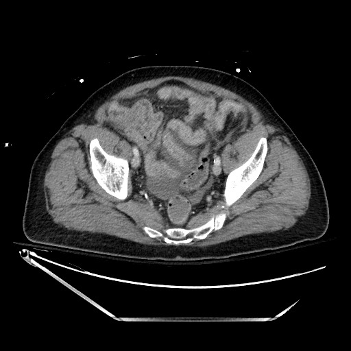 Closed loop obstruction due to adhesive band, resulting in small bowel ischemia and resection (Radiopaedia 83835-99023 D 130).jpg