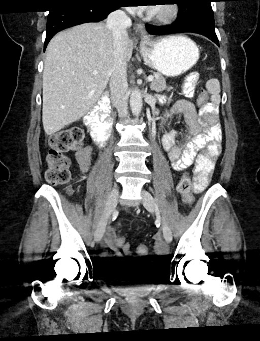 Closed loop small bowel obstruction - adhesions (Radiopaedia 59078-66369 B 66).jpg