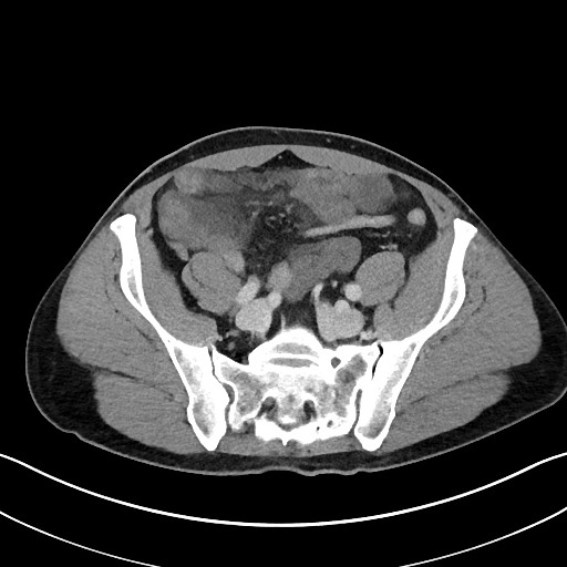 Closed loop small bowel obstruction - internal hernia (Radiopaedia 57806-64778 B 94).jpg