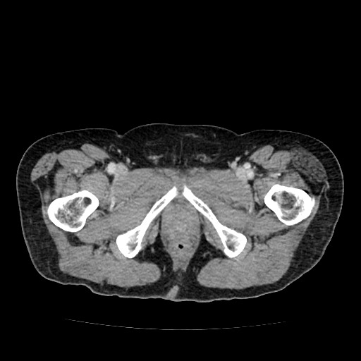 File:Closed loop small bowel obstruction due to adhesive band - U-shaped loop (Radiopaedia 83829-99012 A 75).jpg