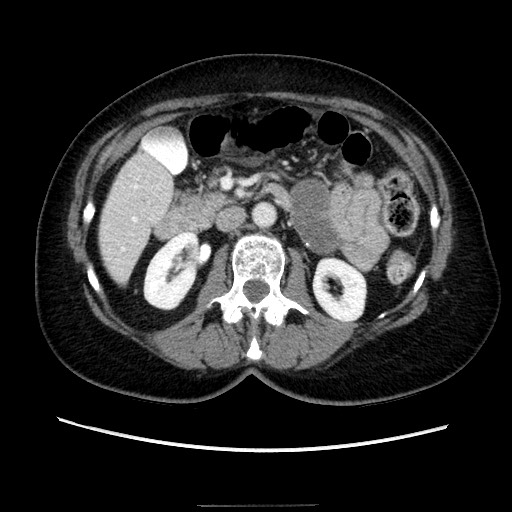 Closed loop small bowel obstruction due to adhesive bands - early and late images (Radiopaedia 83830-99015 A 64).jpg