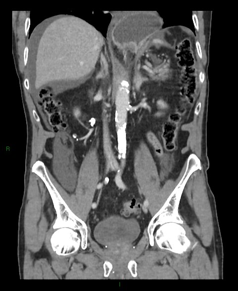 Closed loop small bowel obstruction with ischemia (Radiopaedia 84180-99456 B 31).jpg