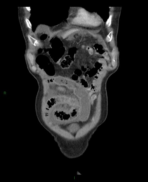 Closed loop small bowel obstruction with ischemia (Radiopaedia 84180-99456 B 58).jpg