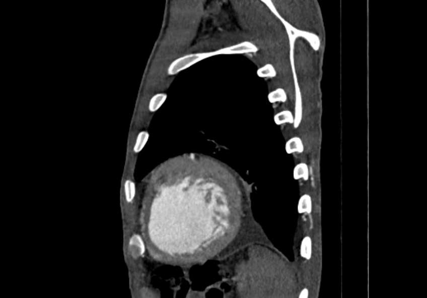 Coarctation of aorta with aortic valve stenosis (Radiopaedia 70463-80574 B 203).jpg
