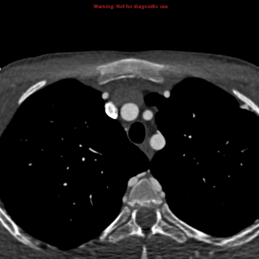 File:Coarctation of the aorta (Radiopaedia 12461-12697 A 2).jpg