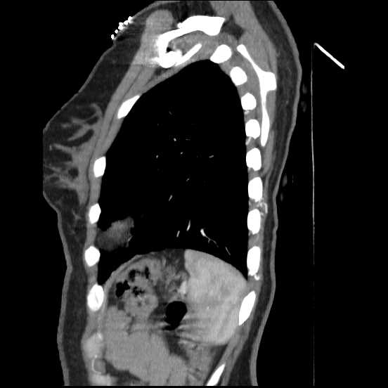 File:Coarctation of the aorta (Radiopaedia 67609-77010 C 12).jpg