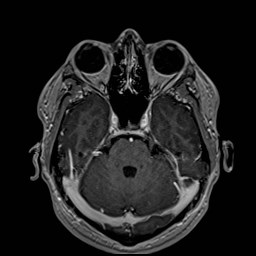 Cochlear incomplete partition type III associated with hypothalamic hamartoma (Radiopaedia 88756-105498 Axial T1 C+ 70).jpg