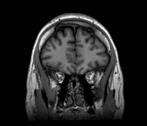 Cochlear incomplete partition type III associated with hypothalamic hamartoma (Radiopaedia 88756-105498 Coronal T1 49).jpg