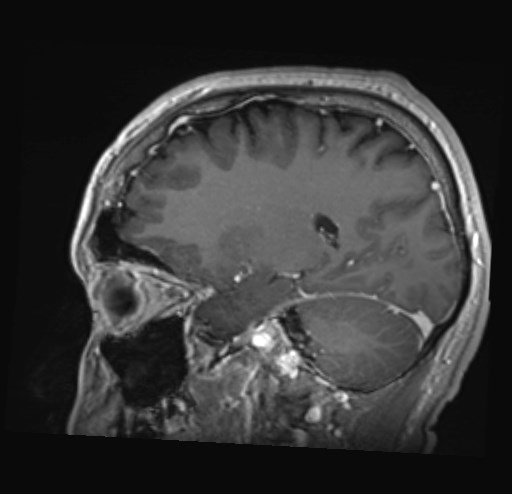 Cochlear incomplete partition type III associated with hypothalamic hamartoma (Radiopaedia 88756-105498 Sagittal T1 C+ 35).jpg