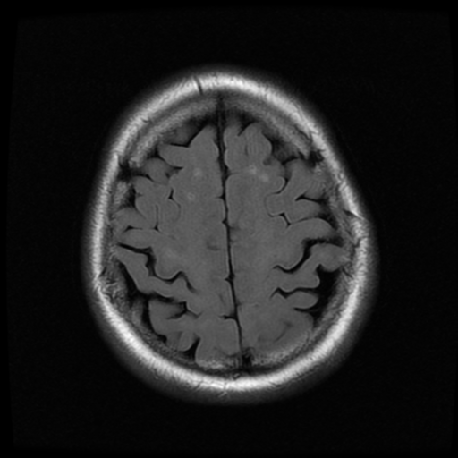 File:Colloid cyst (large) (Radiopaedia 34415-35729 Axial FLAIR 19).png