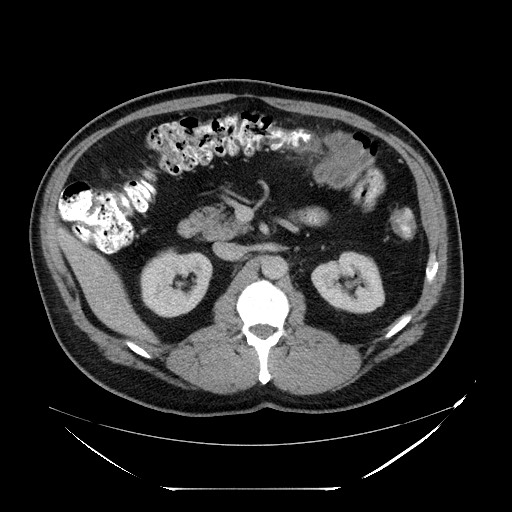 Colocolic intussusception due to lipoma (Radiopaedia 73712-84508 A 43).jpg