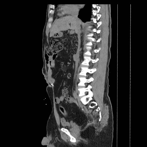File:Colocutaneous fistula in Crohn's disease (Radiopaedia 29586-30093 C 19).jpg