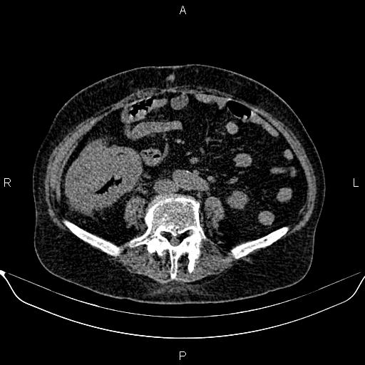 File:Colon cancer (Radiopaedia 90215-107432 Axial non-contrast 56).jpg