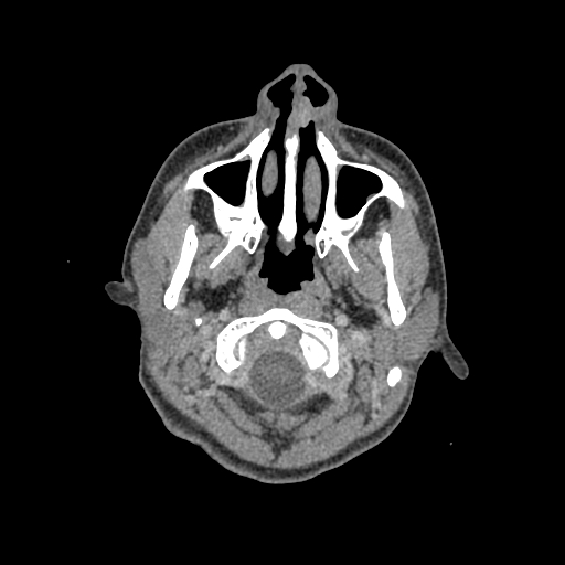 Nasal pyogenic granuloma (lobular capillary hemangioma) (Radiopaedia 85536-101244 C 15).jpg