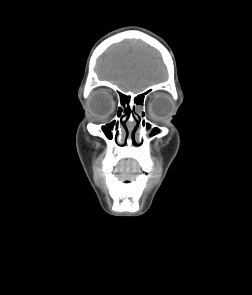 Nasal pyogenic granuloma (lobular capillary hemangioma) (Radiopaedia 85536-101244 Coronal non-contrast 61).jpg