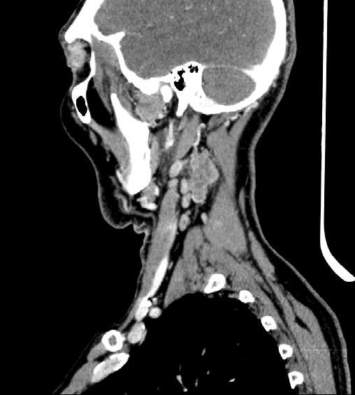 File:Nasopharyngeal carcinoma - infiltrating the clivus (Radiopaedia 62583-70875 C 12).jpg