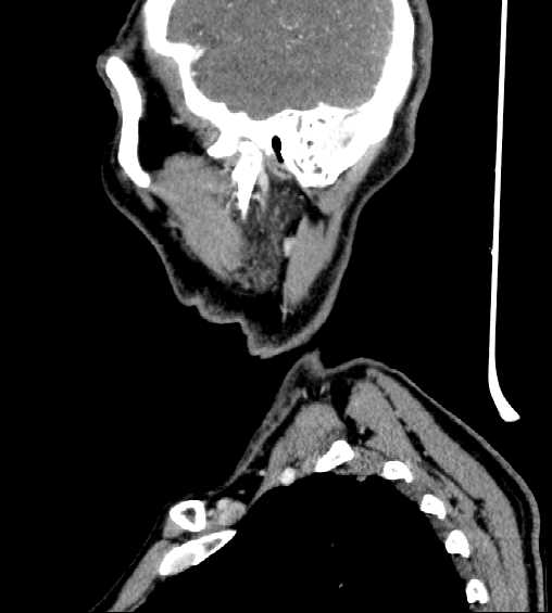 File:Nasopharyngeal carcinoma - infiltrating the clivus (Radiopaedia 62583-70875 C 45).jpg