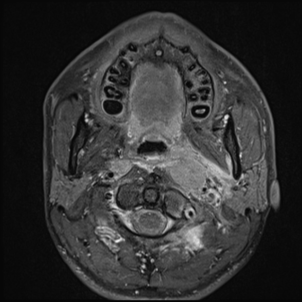 Nasopharyngeal carcinoma with skull base invasion (Radiopaedia 53415-59485 Axial T1 C+ fat sat 34).jpg