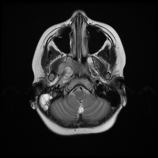 File:Nasopharyngeal rhabdomyosarcoma (Radiopaedia 23417-23486 Axial T2 4).jpg