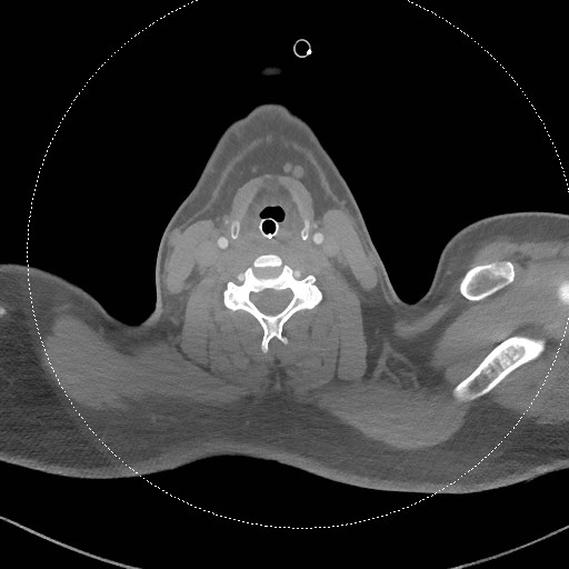 File:Neck CT angiogram (intraosseous vascular access) (Radiopaedia 55481-61945 B 167).jpg