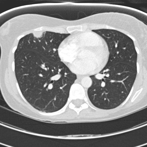 Necrobiotic pulmonary nodules - Crohn disease (Radiopaedia 20723-20631 Axial lung window 85).jpg