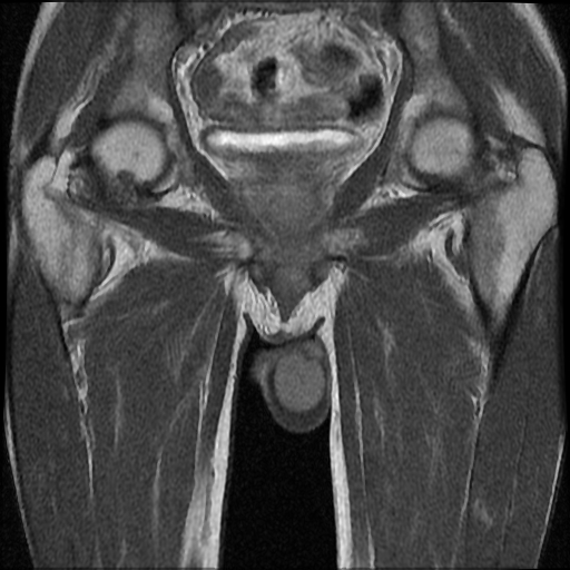 File:Necrotizing epididymo-orchitis with intra-testicular abscess (Radiopaedia 29397-29860 Coronal T1 C+ 16).jpg