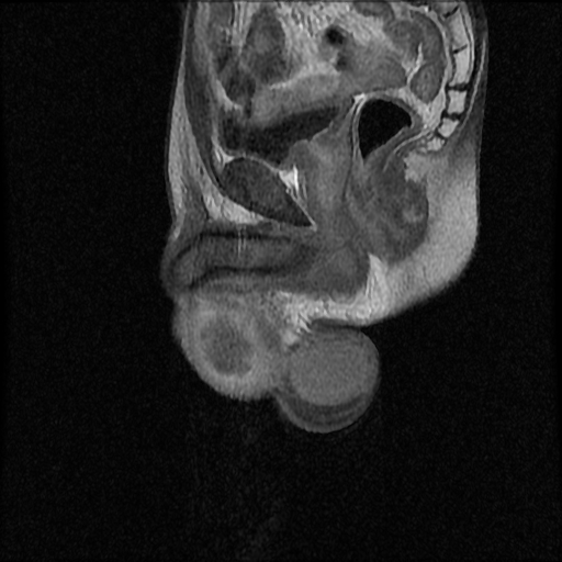 File:Necrotizing epididymo-orchitis with intra-testicular abscess (Radiopaedia 29397-29860 Sagittal T1 C+ 10).jpg