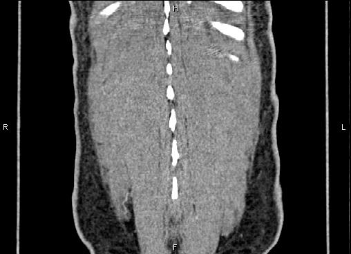 Necrotizing pancreatitis (Radiopaedia 87796-104248 F 66).jpg